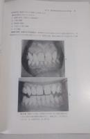 歯周疾患の咬合治療