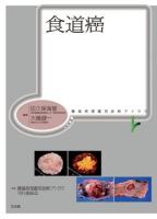 食道癌 ＜腫瘍病理鑑別診断アトラス＞