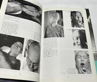 原爆症　改訂新版　Atomic Bomb Injuries
