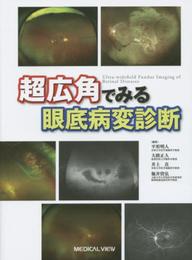 超広角でみる眼底病変診断?病巣を見逃さないために