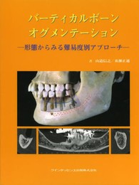 バーティカルボーンオグメンテーション