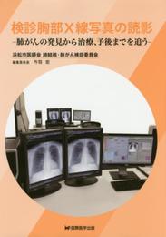 健診胸部X線写真の読影: 肺がんの発見から治療、予後までを追う
