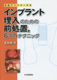 写真でマスターするインプラント埋入のための前処置6つのテクニック