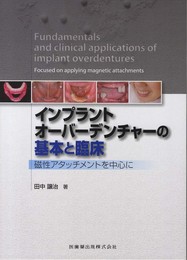 インプラントオーバーデンチャーの基本と臨床磁性アタッチメントを中心に