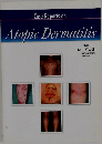 Case Reports on  Atopic Dermatitis