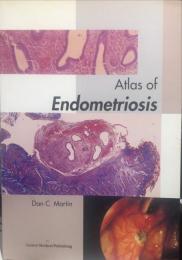 Atlas of　Endometriosis