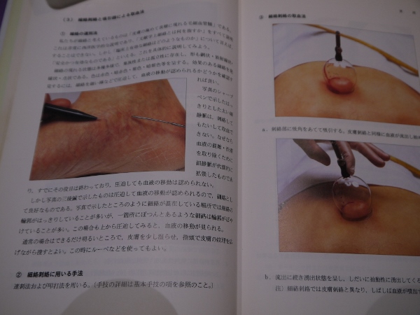 刺絡鍼法マニュアル 日本刺絡学会 / あんず古書店 / 古本、中古