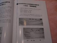 スポットサーマル刺激装置　BANSHIN療法