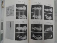 鍼灸医療過誤　折針・気胸・急死　１６７P