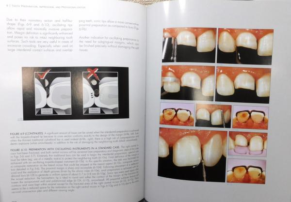 洋書『Bonded Porcelain Restorations in the Anterior Dentition: A