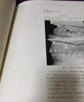 反対咬合の矯正診断と治療